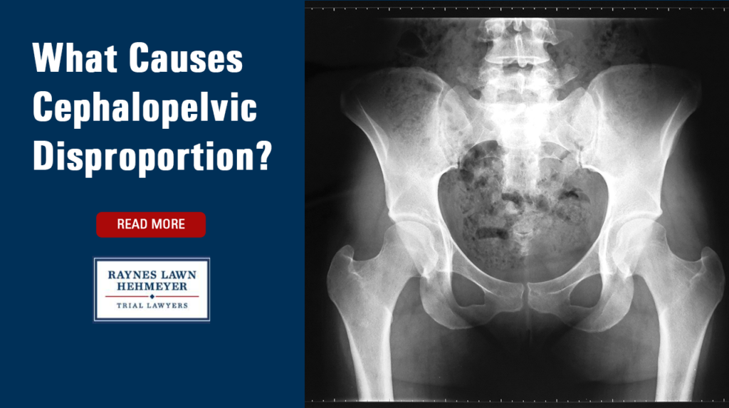 What Causes Cephalopelvic Disproportion?