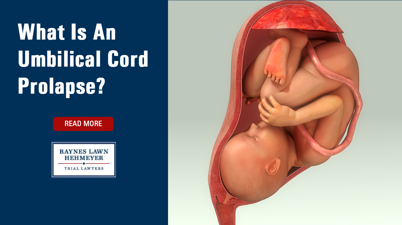 What Is An Umbilical Cord Prolapse?