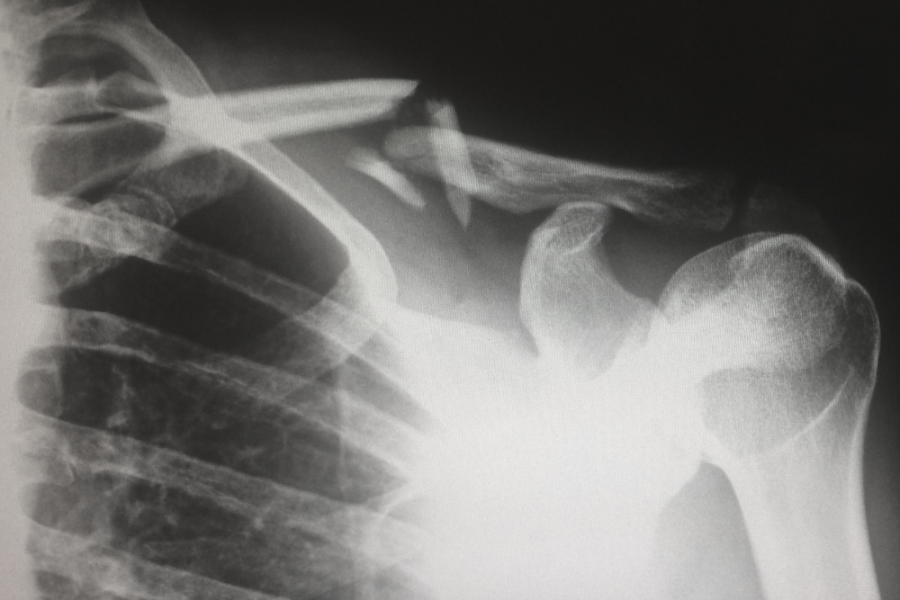 Types Of Shoulder Injuries From Motorcycle Accidents