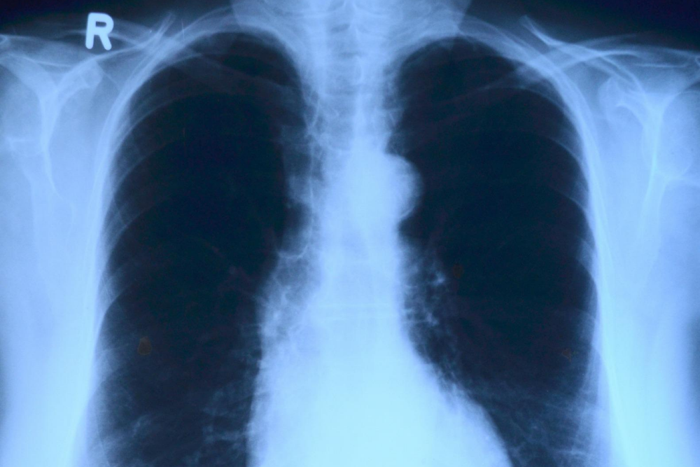What Causes Lung Cancer?