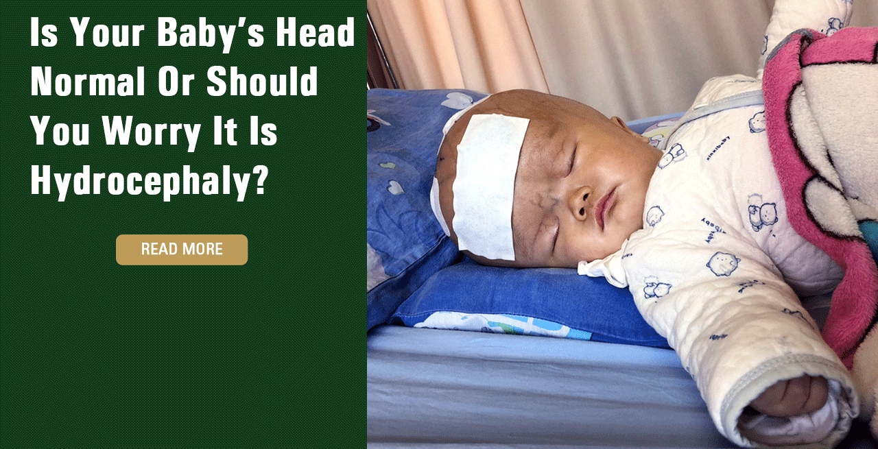 Is Your Baby’s Head Normal Or Should You Worry It Is Hydrocephaly