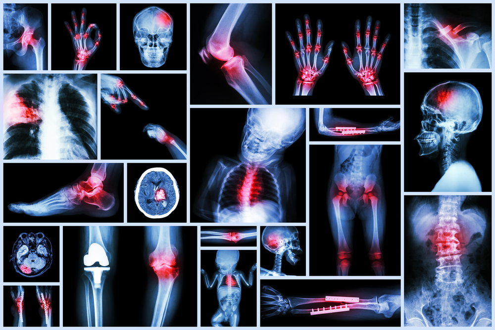 Common Bones Fractured in Accidents
