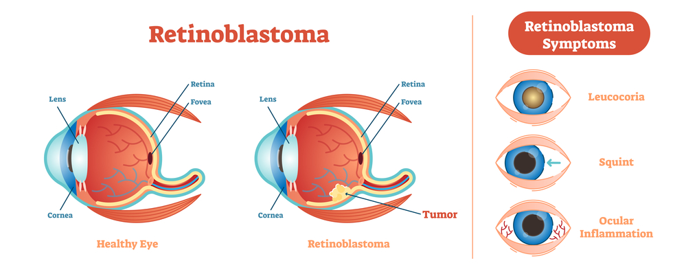 Symptoms and Signs of Retinoblastoma