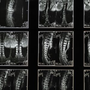 MRIs and DWIs can be used to spot injuries, such as this imagine of a spine. However, correlating diffusion restriction with clinical deterioration takes more than an image but a documented sequence.