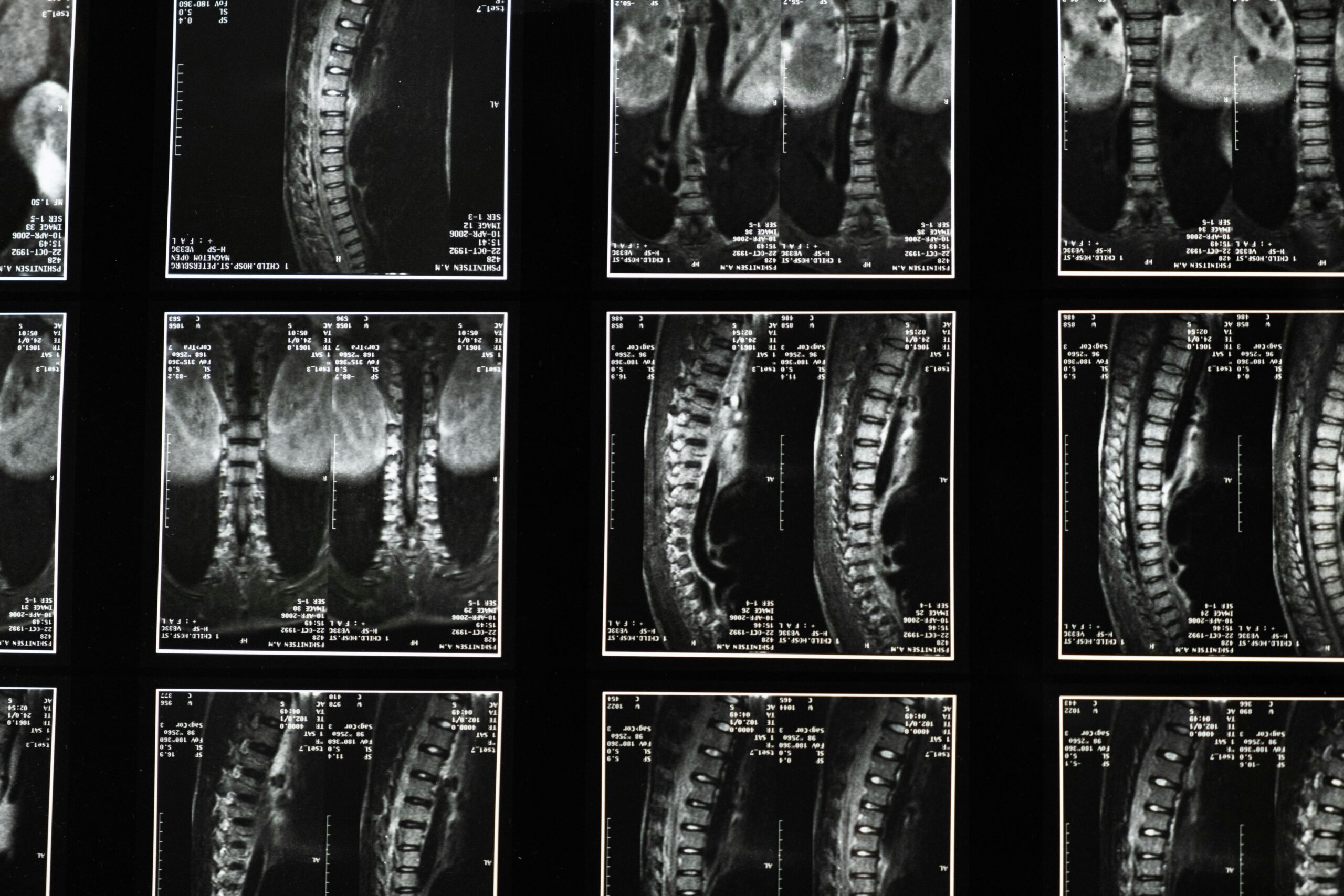 MRIs and DWIs can be used to spot injuries, such as this imagine of a spine. However, correlating diffusion restriction with clinical deterioration takes more than an image but a documented sequence.