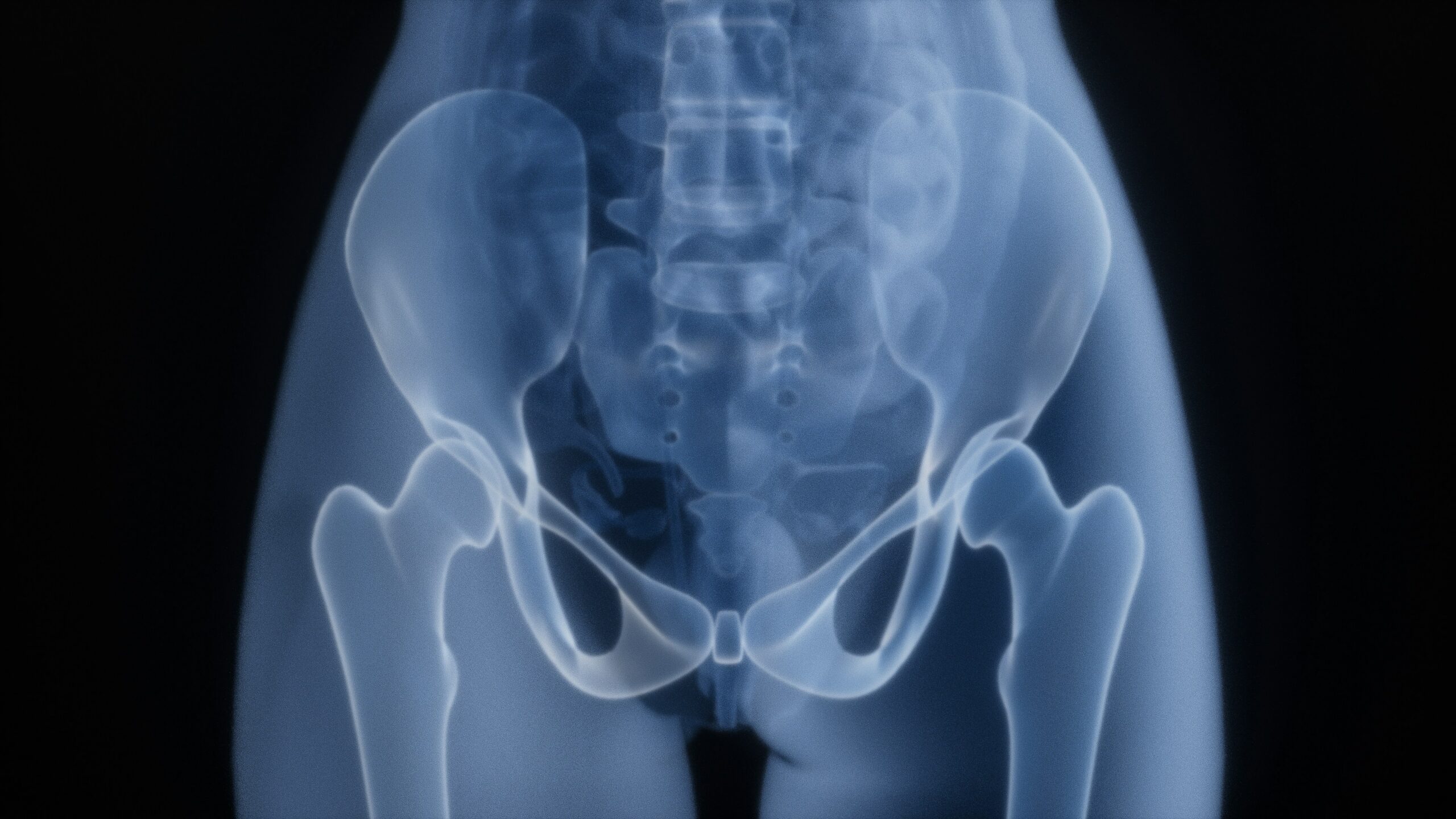 An x-ray of a pelvis. Pelvic fractures are common injuries in truck collisions and may result in long-lasting pain and disability.