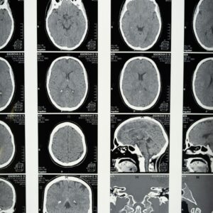 Images of a brain. The delayed diagnosis of traumatic brain injuries can result in irreversible damages to the plaintiff.