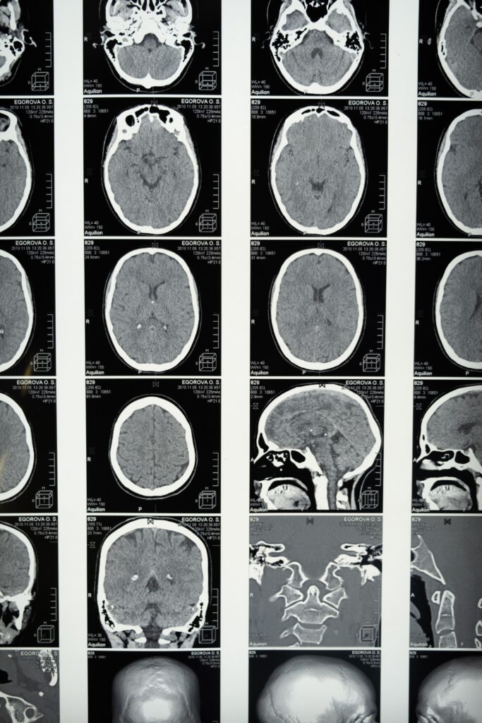 Images of a brain. The delayed diagnosis of traumatic brain injuries can result in irreversible damages to the plaintiff.