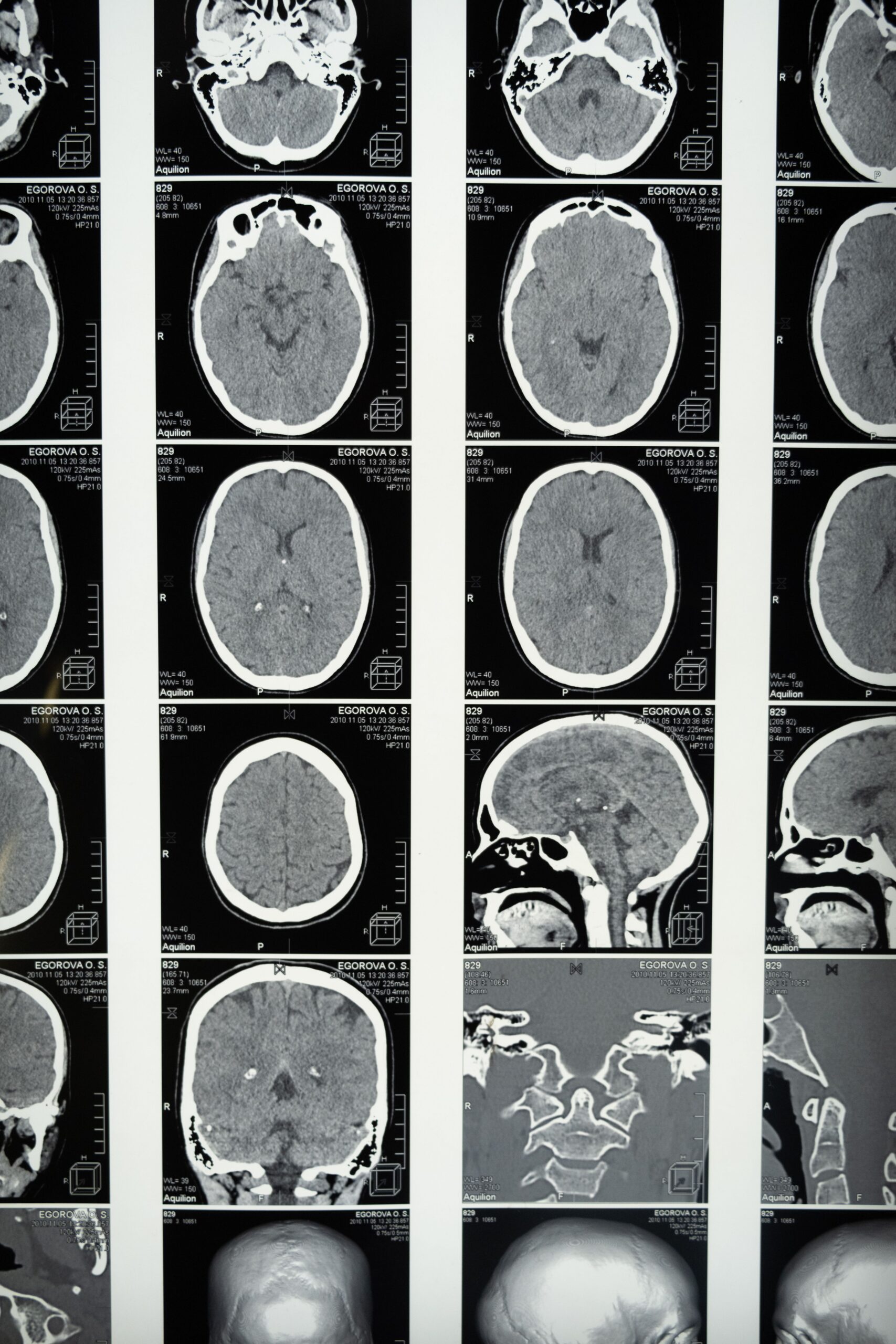 Images of a brain. The delayed diagnosis of traumatic brain injuries can result in irreversible damages to the plaintiff.