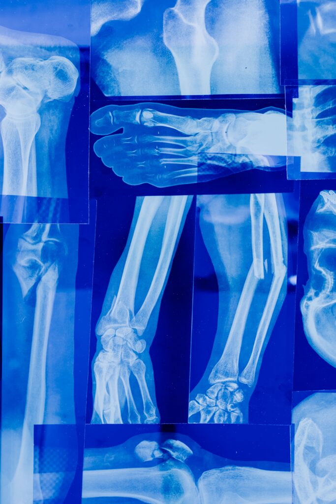 X-rays of multiple fractures