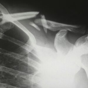An x-ray of a broken collarbone that occurred during a truck accident. Even seemingly minor injuries can have long-term effects that contribute to an individual's lost earning capacity.