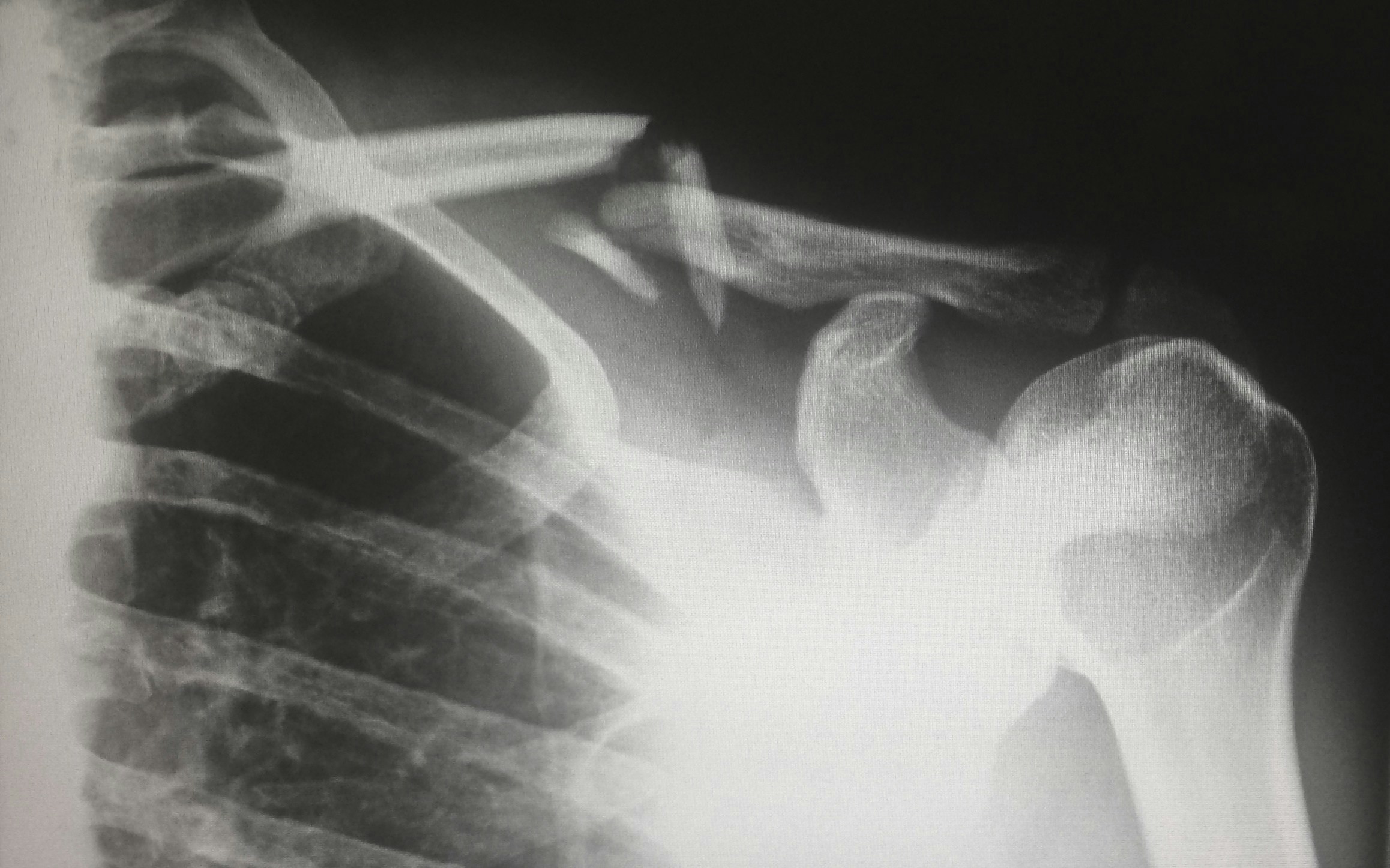 An x-ray of a broken collarbone that occurred during a truck accident. Even seemingly minor injuries can have long-term effects that contribute to an individual's lost earning capacity.